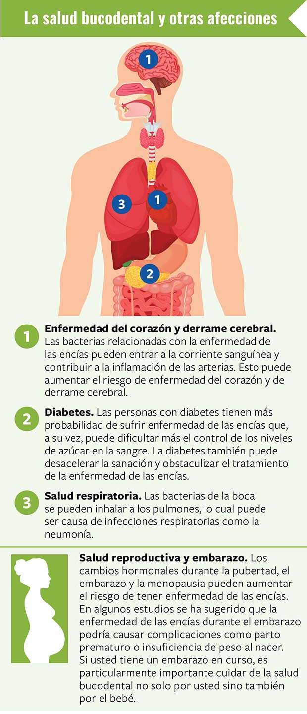 La salud bucodental y otras afecciones. Enfermedad del corazón y derrame cerebral.Las bacterias relacionadas con la enfermedad de las encías pueden entrar a la corriente sanguínea y contribuir a la inflamación de las arterias. Esto puede aumentar el riesgo de enfermedad del corazón y de derrame cerebral.Diabetes. Las personas con diabetes tienen más probabilidad de sufrir enfermedad de las encías que, a su vez, puede dificultar más el control de los niveles de azúcar en la sangre. La diabetes también puede desacelerar la sanación y obstaculizar el tratamiento de la enfermedad de las encías.Salud respiratoria. Las bacterias de la boca se pueden inhalar a los pulmones, lo cual puede ser causa de infecciones respiratorias como la neumonía. Salud reproductiva y embarazo. Los cambios hormonales durante la pubertad, el embarazo y la menopausia pueden aumentar el riesgo de tener enfermedad de las encías. En algunos estudios se ha sugerido que la enfermedad de las encías durante el embarazo podría causar complicaciones como parto prematuro o insuficiencia de peso al nacer. Si usted tiene un embarazo en curso, es particularmente importante cuidar de la salud bucodental no solo por usted sino también por el bebé.